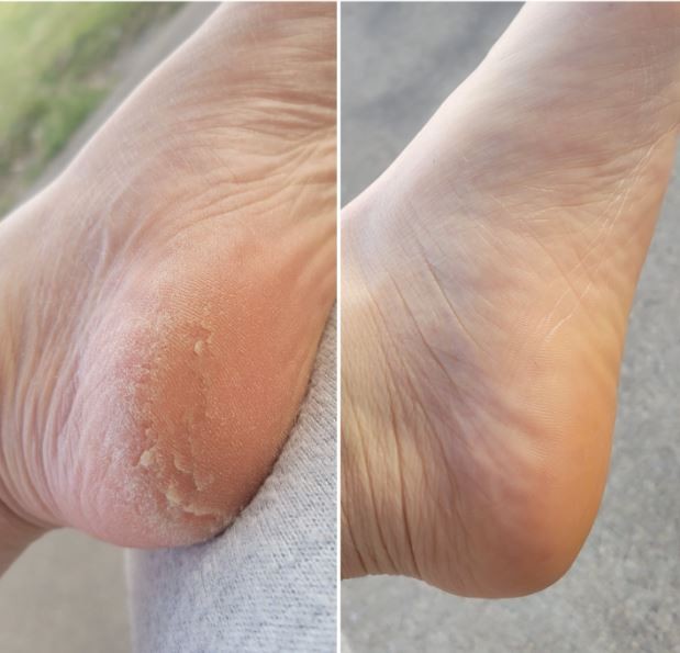 Foot Pedicure Callus Remover – shopnormad